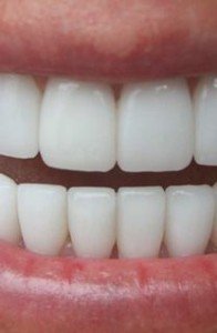 cosmetic-dentistrymethodsfor better teeth